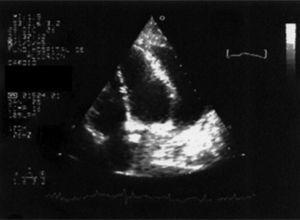 Ecocardiograma 2D visión de 4 cavidades: se observa derrame pericárdico severo concéntrico (3 cm en caras anterior y posterior). Ventrículo izquierdo no dilatado ni hipertrófico.