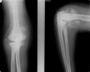 Radiografía anteroposterior y lateral de codo derecho. Se observa destrucción articular con erosiones a nivel del húmero, importantes cambios esclerosos periarticulares, osteocondromatosis evolucionada y pinzamiento articular.