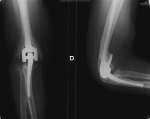 Radiografía anteroposterior y lateral de codo derecho (a los 4 años de la cirugía). Se observa material protésico a nivel del codo derecho.