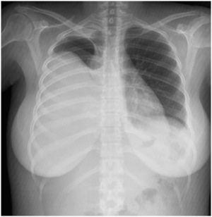 Radiografía de tórax posteroanterior con derrame pleural derecho.