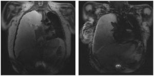 Resonancia magnética de tórax con presencia de derrame pleural bilateral con predominio derecho.