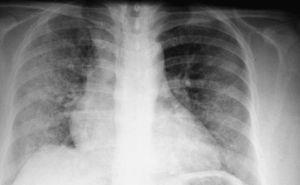 Radiografía de tórax con opacidades heterogéneas bilaterales diseminadas en paciente con diagnóstico de hemorragia alveolar difusa.
