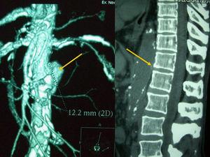 Caso clínico 2. A la izquierda puede observarse una reconstrucción bidimensional del aneurisma aórtico abdominal del paciente, mediante TAC. A la derecha, se observa la erosión vertebral que el mismo aneurisma ocasionaría sobre los cuerpos vertebrales.