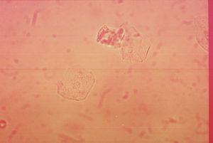 Células epiteliales en SU (400×).