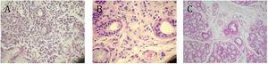 Microfotografías representativas de glándulas salivares menores de pacientes con síndrome de Sjögren (SSp). A) Paciente del grupo A, en donde se observa infiltrado linfoplasmocitario focal y atrofia acinar. B) Paciente del grupo B, con sialoadenitis: infiltrado linfoplasmocitario disperso intersticial con presencia de polimorfonucleares. C) Paciente del grupo C, donde se observa glándula con características conservadas sin focos linfoplasmocitarios ni tampoco infiltrado intersticial. HE-40X.