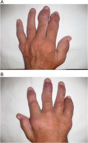 Tumefacción articular y tofos en mano izquierda (A) y derecha (B).