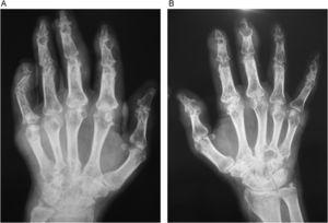 Rx con aumento de partes blandas y erosiones de mano derecha (A) y mano izquierda (B).