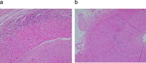 a) Se observa inflamación aguda y crónica con presencia de células gigantes y fragmentación de la elástica interna. b) Fragmento de pared arterial con ausencia de inflamación, junto a fibrosis y neovascularización de la capa media.