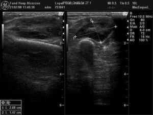 Ecografia antebrazo izq: Se observa una tumoración ovalada, sólida de 36×26×14mm, bien delimitada con flujo arterial en su interior. En el plano muscular lateral del antebrazo izquierdo se observa una tumoración ovalada sólida de 36×26×14mm, bien delimitada por un anillo ecogénico, predominantemente hipoecogénica respecto a la musculatura adyacente, con una zona central hiperecogénica. Se observa flujo arterial en el interior de la tumoración en el estudio con Doppler.