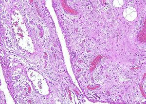 Zona de la sinovial con tejido de granulación e inflamación crónica.
