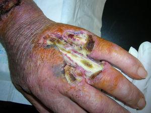 Lesiones ulceradas de dorso de la mano izquierda con exposición tendinosa.