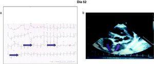 a) Electrocardiograma que muestra ritmo sinusal, FC 125, a P +30°, eje QRS +60°, PR 0,12, Qtc 0,40, Ondas Q en DII, aVF y V6. b) Ecocardiograma en el que se aprecia aneurisma de la coronaria derecha de 0,1 cm2; coronaria izquierda descendente anterior de 6,8 mm; origen de ambas coronarias de 3 mm; FE del 61%.