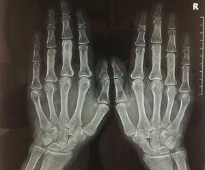 Radiología posteroanterior de las manos, en la que destaca la afectación de la tercera falange de la mano izquierda, siendo el resto de la imagen radiográfica normal.