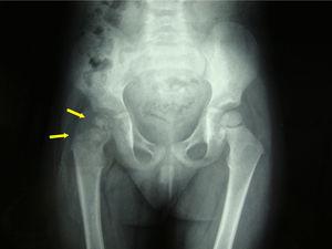 Radiografía simple caderas: desestructuración cabeza femoral derecha.
