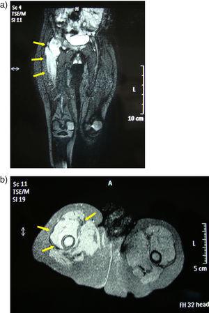A) RM de cadera. B) RM de cadera derecha: osteoartritis séptica coxo-femoral derecha con osteomielitis femoral coexistente que afecta a la mitad proximal del fémur.