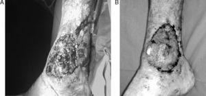 A) Pioderma gangrenoso en tobillo derecho. B) Mejoría de la lesión tras tratamiento con infliximab.