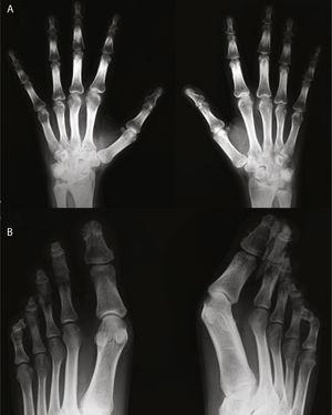 Radiografía de manos (A) en la que se observa reacción perióstica en radio. Ensanchamiento distal con cambios hipertróficos en los penachos y áreas de osteolisis en los mismos, de las que es un buen ejemplo el cuarto dedo de la mano derecha. Desmineralización yuxtaarticular. Radiografía de pies (B) en la que se observan marcados cambios destructivos en falanges distales, algunas con morfología aplanada y penachos distales hipertróficos con proliferación ósea. Marcada deformidad de los dedos en palillo de tambor.