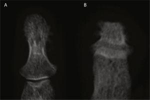Imagen comparativa de falange distal de la mano (A) y del pie (B); en la primera se observan cambios proliferativos y en la segunda cambios destructivos marcados con morfología aplanada.