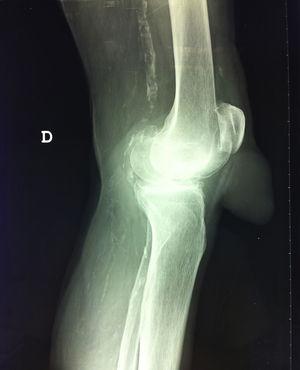 Radiografía lateral en carga de la rodilla.