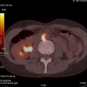 Arteritis de Takayasu. Se observan lesiones hipermetabólicas en la aorta abdominal.
