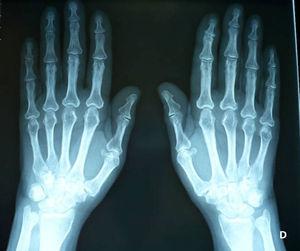 Radiografía simple de manos. Aumento de los tejidos blandos. Periostitis difusa.