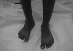 Paciente con síndrome de Noonan, que presenta edema tibial bilateral.