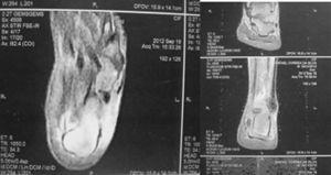 Resonancia magnética de tobillos con edema en la región posterior del calcáneo, engrosamiento y aumento de la densidad en la inserción del tendón de Aquiles izquierdo, con rotura parcial, peritendinitis asociada y bursitis retrocalcánea.