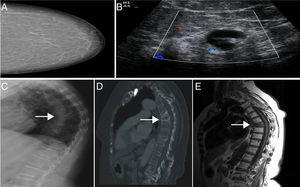 A. mamografía BIRADS I. B. Adenopatía con engrosamiento cortical sospechoso de metástasis. C-E. Se objetiva fractura vertebral de D7, con patrón escleroso en los cortes sagitales de la TC y señales hipointensas en las imágenes de RM potenciadas en T1.