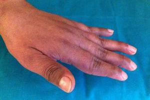 Mano izquierda de la paciente afecta con artropatía de Jaccoud, donde se aprecia la desviación cubital del 5.° dedo y las deformidades en cuello de cisne de los dedos 2.° al 5.°.