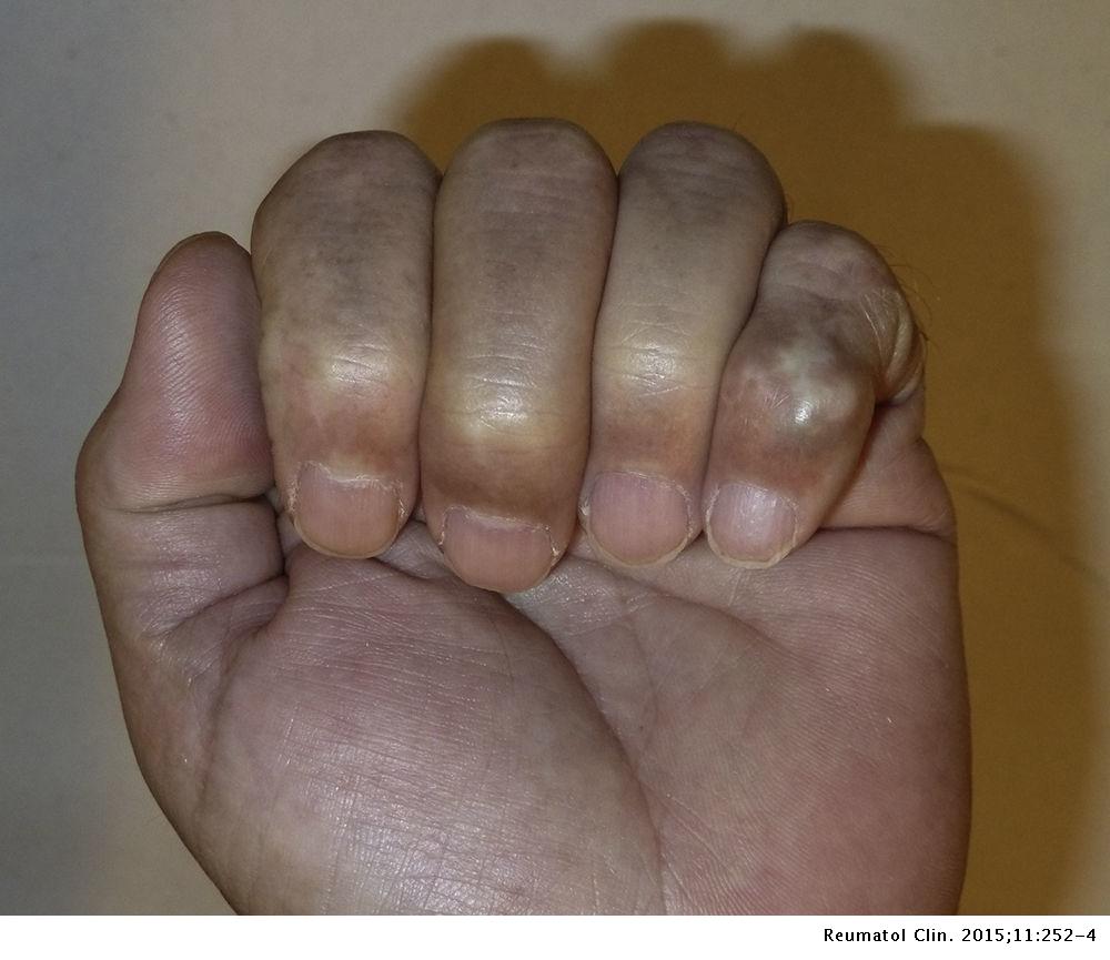 Costa cilindro mini Tumor de células gigantes de las vainas tendinosas de los dedos de la mano  | Reumatología Clínica