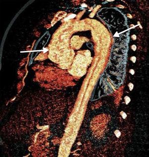 Reconstrucción aórtica mediante resonancia magnética destacando zona de dilatación aórtica en el cayado. Paciente con sialoadenitis por IgG4 con afección aórtica.