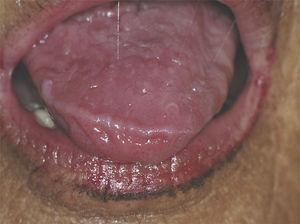 Mujer de 70 años con SSp. La paciente presenta hiposialia, obsérvese el aspecto filante de la saliva.