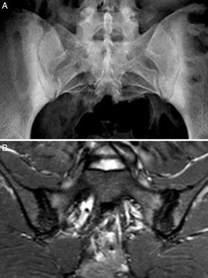 Caso 2. A) Radiografía con marcada esclerosis bilateral en ambos márgenes óseos de las articulaciones sacroiliacas. B) RM de sacroiliacas que muestra esclerosis, erosiones y edema óseo demostrativo de sacroilitis activa.