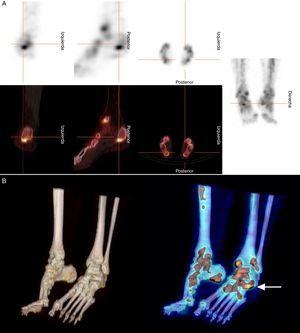 A. SPECT/TC ósea en planos axial, sagital y coronal que muestra aumento de la actividad osteoblástica en el maléolo tibial izquierdo, astrágalo y articulación calcáneo astragalina. (cruz). B. Reconstrucciones 3D de las imágenes de fusión que permiten la localización precisa del punto de atrapamiento (flecha).