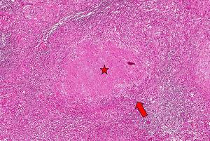 Se aprecian múltiples granulomas conformados por acúmulo de histiocitos epiteloides (flecha) rodeados de linfocitos con necrosis caseosa central (estrella). (HyE, 400×).