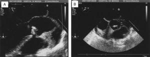 A y B) Ecocardiografía transtorácica. Se muestra imagen de vegetación sobre válvula aórtica bicúspide, parcialmente calcificada con prolapso parcial de la misma y regurgitación severa, sin datos de insuficiencia cardiaca.