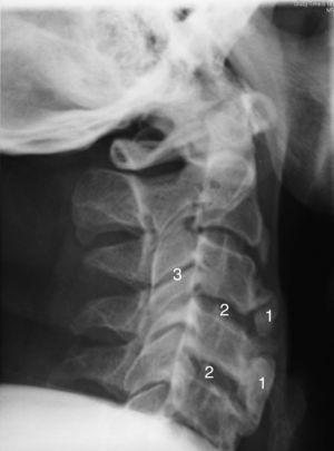 Radiografía cervical lateral (2009). Se aprecia osificación del ligamento anterior cervical, que afecta en mayor medida al segmento inferior cervical (1), los espacios intervertebrales (2) y las articulaciones interapofisarias están conservadas (3).