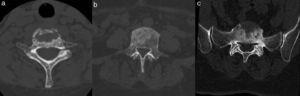 Tomografía computarizada. Lesiones líticas y esclerosas en cuerpos vertebrales de columna cervical (a), dorsal (b) y lumbosacra (c).