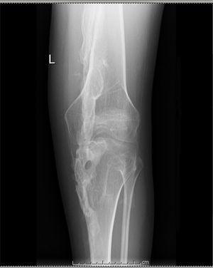 Radiografía de la rodilla izquierda que muestra anquilosis secundaria a puentes óseos.
