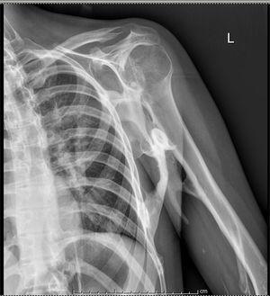 Radiografía de hombro que muestra una placa de hueso maduro bien definida entre la pared torácica, el húmero y la escápula.