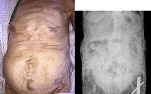 Calcinosis universalis en abdomen y pelvis.