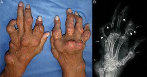 (A) Tophaceous gout with multiple tophi on both hands. (B) The left hand X-ray shows punched-out erosions (thick arrows) with overhanging edges (arrowhead) and soft tissue nodules (thin arrows), findings suggestive of gout.