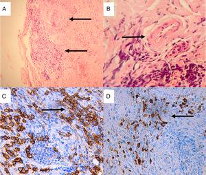 Biopsia de glándula lacrimal. Tinción hematoxilina-eosina: A) Fibrosis estoriforme y esclerosis estromal, infiltrado inflamatorio crónico (×10); B) Venas con paredes engrosadas con infiltración de sus paredes por células inflamatorias mononucleares causando obliteración de la luz. Tinción de inmunohistoquímica (×40). C) Extenso infiltrado de plasmocitos que expresan CD38 (×40 tinción DAB anti-CD38); D) Plasmocitos que expresan IgG4 (×40 tinción DAB anti-IgG4).