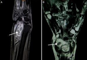 (A) T2W FAT SAT sagittal image show a well defined fluid intensity collection seen along the flexor tendon sheath with presence of hypointense layered rice grain (white arrow) shaped within it suggestive of tenosynovitis with multiple loose bodies. (B) T2W Coronal images show well defined fluid intensity collection anterior to the wrist joint along the flexor tendon sheath suggestive of tenosynovitis. Multiple layered hypointense loose bodies like rice grain are seen within it (arrow).
