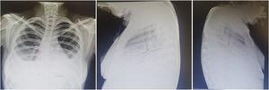 Mujer de 22 años con LEG de 3 años de evolución caracterizado por manifestaciones cutáneas y musculoesqueléticas. Acude por cuadro de un mes de evolución caracterizado por dolor de tipo pleurítico y disnea. La radiografía de tórax simple reveló imágenes radiopacas que obliteran ángulos costodiafragmáticos compatibles con derrame pleural el cual fue abordado y posteriormente atribuido a actividad de su enfermedad de base.
