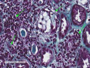 Nefritis túbulo-intersticial y necrosis tubular aguda leve secundaria. Biopsia renal. Infiltrado inflamatorio linfocitario que afecta predominantemente al intersticio y permeación de linfocitos en el epitelio tubular con destrucción parcial de este compatible con NTIA. Escasos túbulos presentan cambios regenerativos con epitelio aplanado y vacuolización citoplasmática con núcleos agrandados de tamaño e hipercromáticos y con descamación epitelial intraluminal (necrosis tubular aguda secundaria) (tricrómico de Masson, 40×).