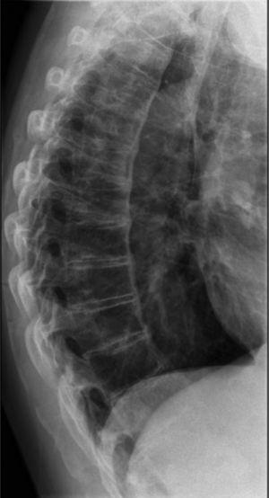 Radiografía columna dorsal: calcificación del ligamento vertebral común anterior.