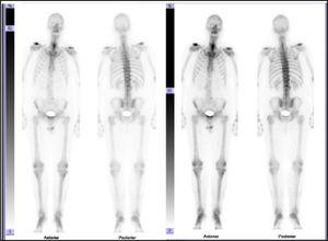 Gammagrafía ósea con patrón normal de captación en el esqueleto cervicodorsal y captación discreta en el lado derecho del raquis lumbar.