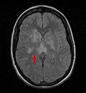 RM cerebral; secuencia fluid-attenuated inversion recovery (FLAIR) transversal; lesiones de hiperintensidad de señal ganglios de la base y sustancia silviana profunda bilateral.