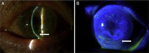 Slit lamp photographs showing a peripheral corneal thinning (A, arrow) with a non-homogeneous distribution of fluorescein stain (B, arrow).